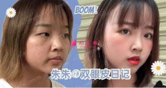 廣州美萊雙眼皮案例|單眼皮妹子30天の變美日記~