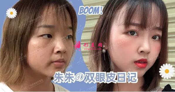 廣州美萊雙眼皮案例|單眼皮妹子30天の變美日記~