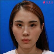 八大處靳小雷顴骨內(nèi)推案例|靳小雷顴骨內(nèi)推怎么樣？