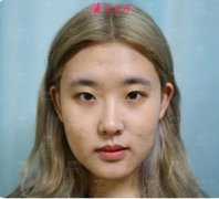 逝去稚嫩 ，鄰家小妹雙眼皮術(shù)后一年半，長成大美妞~