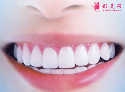 烤瓷牙邊緣變黑是怎么回事