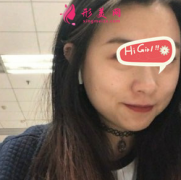 濟南愛容整形美容醫(yī)院熱瑪吉提升 皮膚緊致有彈性 美美噠