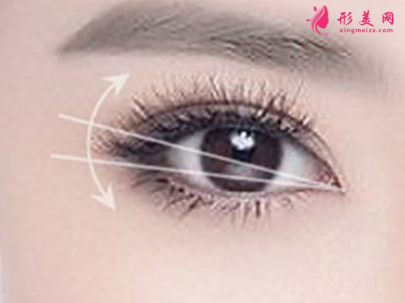 開(kāi)眼角后疤痕增生怎么修復(fù)
