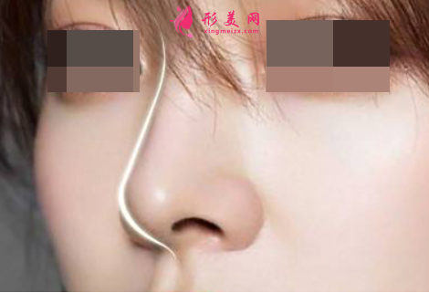做了假體隆鼻鼻子會(huì)歪嗎