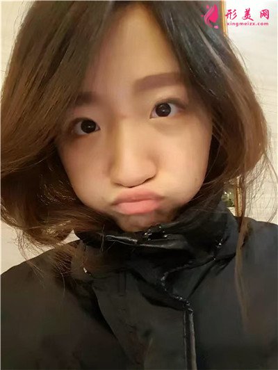 武漢小姐姐眼部綜合術后恢復情況反饋
