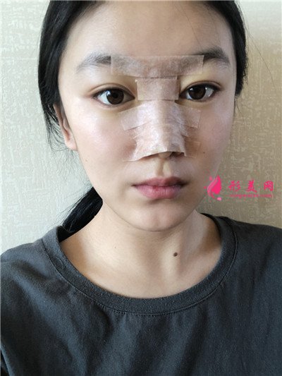 成都自體肋軟骨隆鼻案例分享，小姐姐的五官好立體呀~