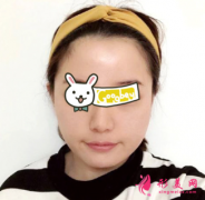 北京禾美嘉醫(yī)療美容整形醫(yī)院面部吸脂后擺脫肉肉臉，真的不會(huì)反彈