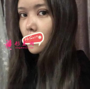北京煤炭總醫(yī)院整形美容中心假體隆鼻后 顏值飆升 好開心