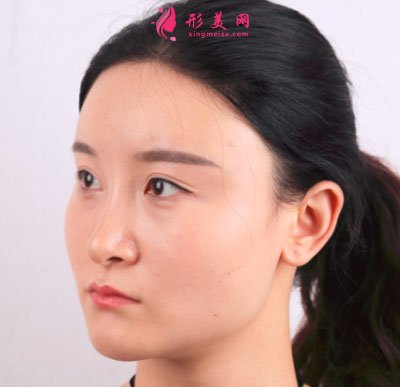 上海華美醫(yī)療美容醫(yī)院V-LINE瓜子臉手術案例