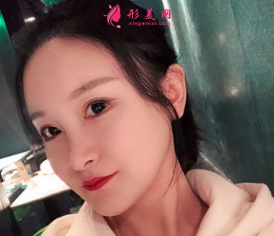 上海華美醫(yī)療美容醫(yī)院V-LINE瓜子臉手術案例