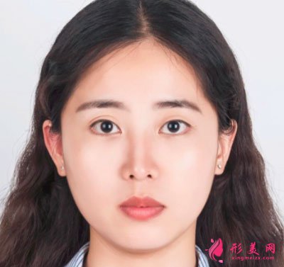 廈門美萊醫(yī)療美容醫(yī)院眼部多項案例