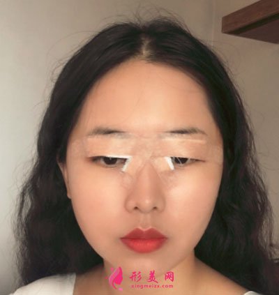 廈門美萊醫(yī)療美容醫(yī)院眼部多項案例