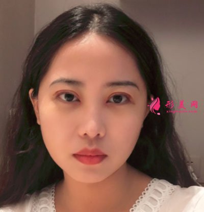 廈門美萊醫(yī)療美容醫(yī)院眼部多項案例