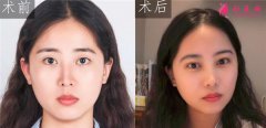 到廈門美萊醫(yī)療美容醫(yī)院做的眼部多項怎么樣？真人案例對比分