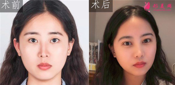 廈門美萊醫(yī)療美容醫(yī)院眼部多項案例
