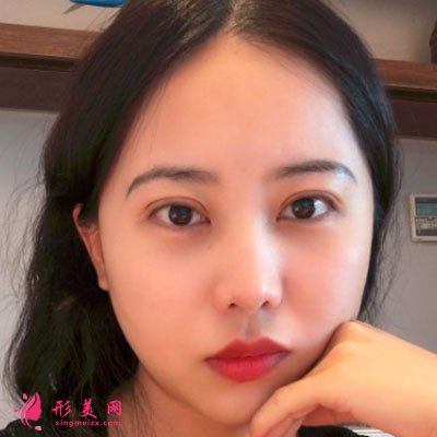 廈門美萊醫(yī)療美容醫(yī)院眼部多項案例