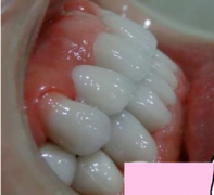 杭州格萊美醫(yī)院整牙價(jià)格表，看牙齒矯正術(shù)后效果實(shí)拍