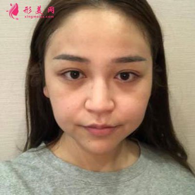 杭州瑞麗整形美容醫(yī)院隆鼻案例