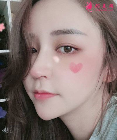 杭州瑞麗整形美容醫(yī)院隆鼻案例