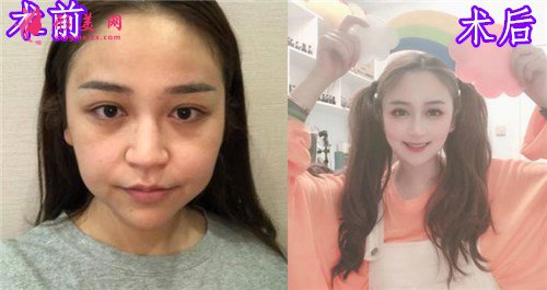 杭州瑞麗整形美容醫(yī)院隆鼻案例
