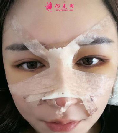 杭州瑞麗整形美容醫(yī)院隆鼻案例