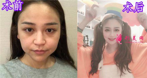杭州瑞麗整形美容醫(yī)院隆鼻案例