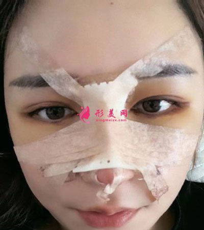 杭州瑞麗整形美容醫(yī)院隆鼻案例