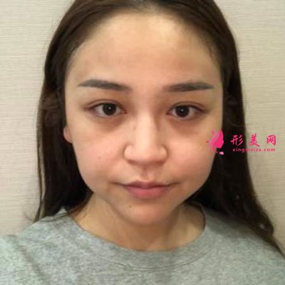 杭州瑞麗整形美容醫(yī)院隆鼻案例