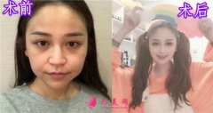 杭州瑞麗整形美容醫(yī)院隆鼻怎么樣？案例對(duì)比圖