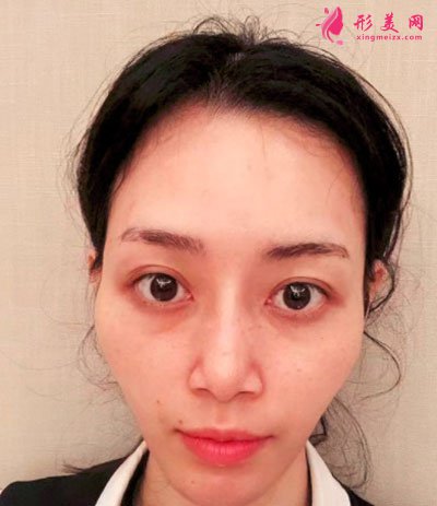 蘇州美貝爾整形美容醫(yī)院自體脂肪面部填充案例