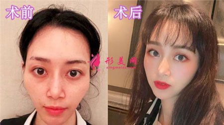 蘇州美貝爾整形美容醫(yī)院自體脂肪面部填充案例