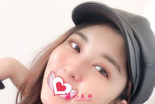 找上海美聯(lián)臣李炅默做的雙眼皮 40天術(shù)后效果恢復(fù)得簡(jiǎn)直太好了