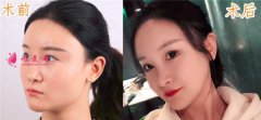 一起來看看在上海華美醫(yī)療美容醫(yī)院做的V-LINE瓜子臉手術(shù)案例分享