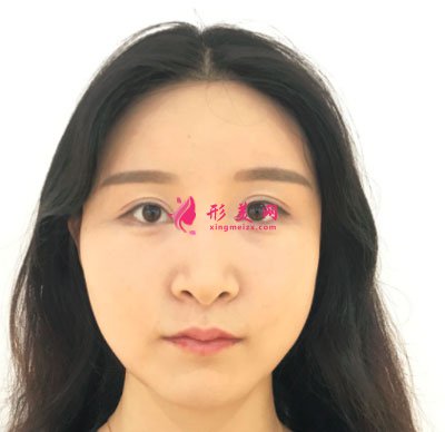 上海華美醫(yī)療美容醫(yī)院V-LINE瓜子臉手術(shù)案例