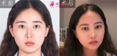 到廈門美萊醫(yī)療美容醫(yī)院做的眼部多項怎么樣？真人案例對比分享