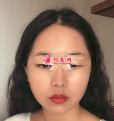 廈門美萊醫(yī)療美容醫(yī)院眼部多項(xiàng)案例