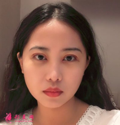 廈門美萊醫(yī)療美容醫(yī)院眼部多項(xiàng)案例