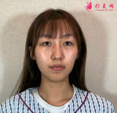 寧波靜港整形自體脂肪面部填充案例
