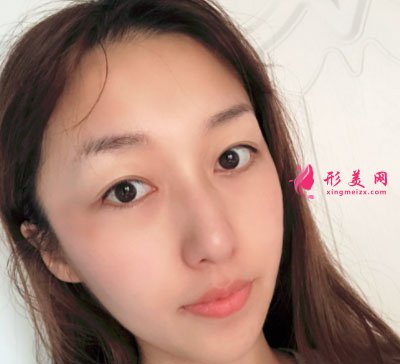 寧波靜港整形自體脂肪面部填充案例