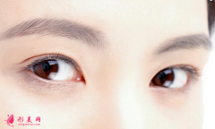 切開雙眼皮的恢復(fù)時(shí)間長嗎？