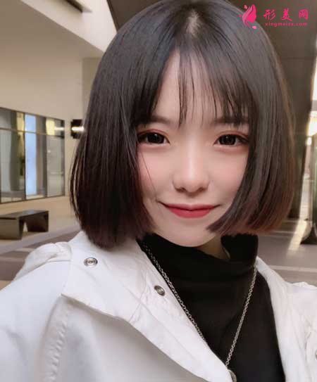 青島市中心醫(yī)院整形美容科做雙眼皮案例分享