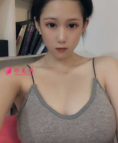 成都美萊醫(yī)院吳江山為我做的假體隆胸手術(shù)后20天