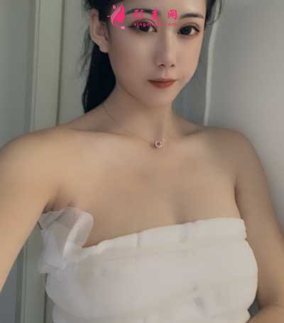 成都美萊醫(yī)院吳江山為我做的假體隆胸手術(shù)后5天