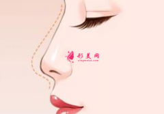 自體軟骨隆鼻可以保持多長時(shí)間？