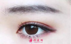 切開(kāi)雙眼皮老了會(huì)消失嗎？