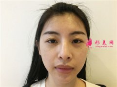 廣州可玉醫(yī)療美容M唇術(shù)后恢復(fù)情況分享