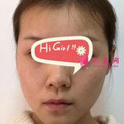上海九院整形科熱瑪吉除皺后法令紋消失了 年輕好幾歲