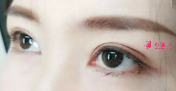 埋線雙眼皮一般多少錢