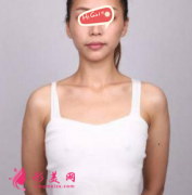 北京麗都整形醫(yī)院假體隆胸效果超棒 胸部豐滿 超性感