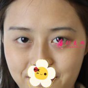北京藝星整形醫(yī)院眼綜合效果圖 雙眸有神 素顏也是美美噠